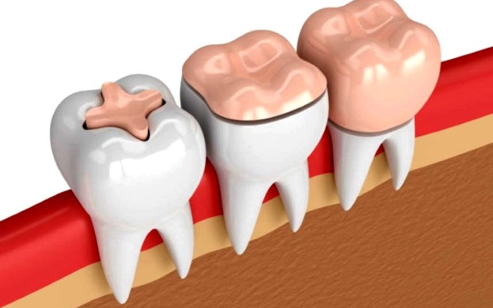 Tévhitek a fogápolásban, avagy a fogvesztés leggyakoribb okai