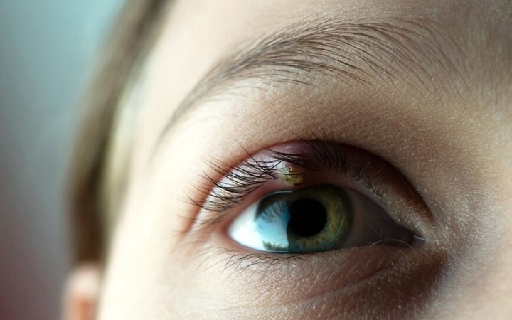 Amit tudni kell erről a szembetegségről: árpa